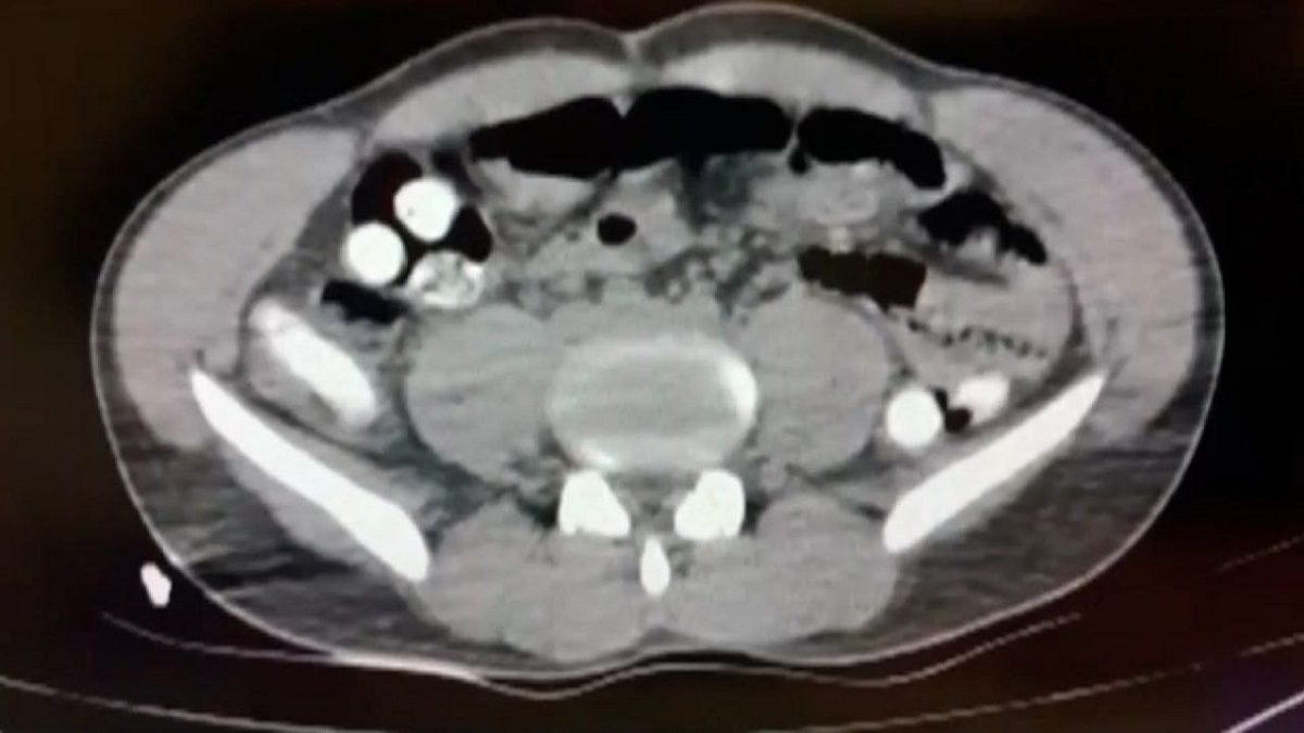 مسافر ایرانی با یک کیلو تریاک در معده به دام پلیس ترکیه افتاد (+عکس) مسافر ایرانی با یک کیلو تریاک در معده به دام پلیس ترکیه افتاد (+عکس)