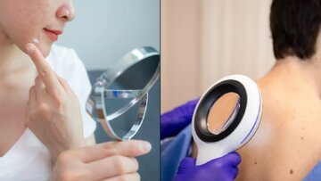 کدام جوشها نشانه سرطان پوست است؟