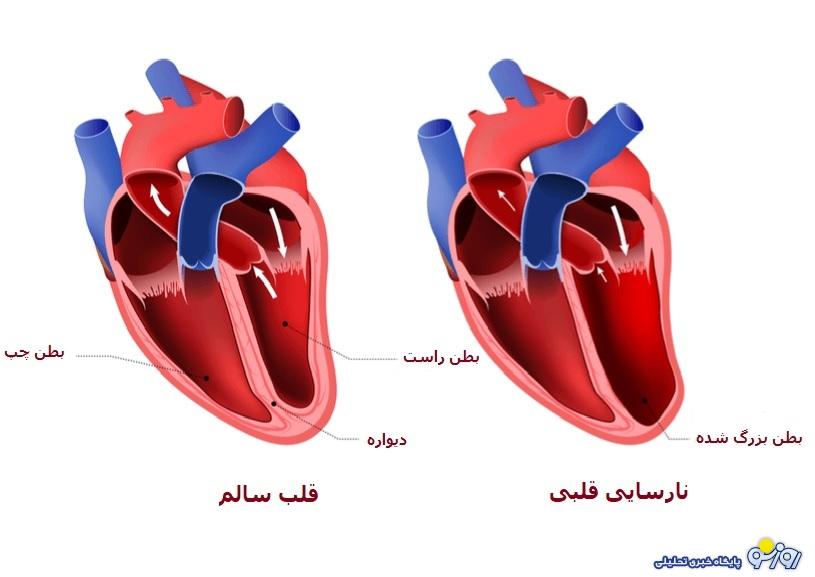 نشانه‌های نارسایی قلبی چیست و راه‌های درمانی آن کدامند؟