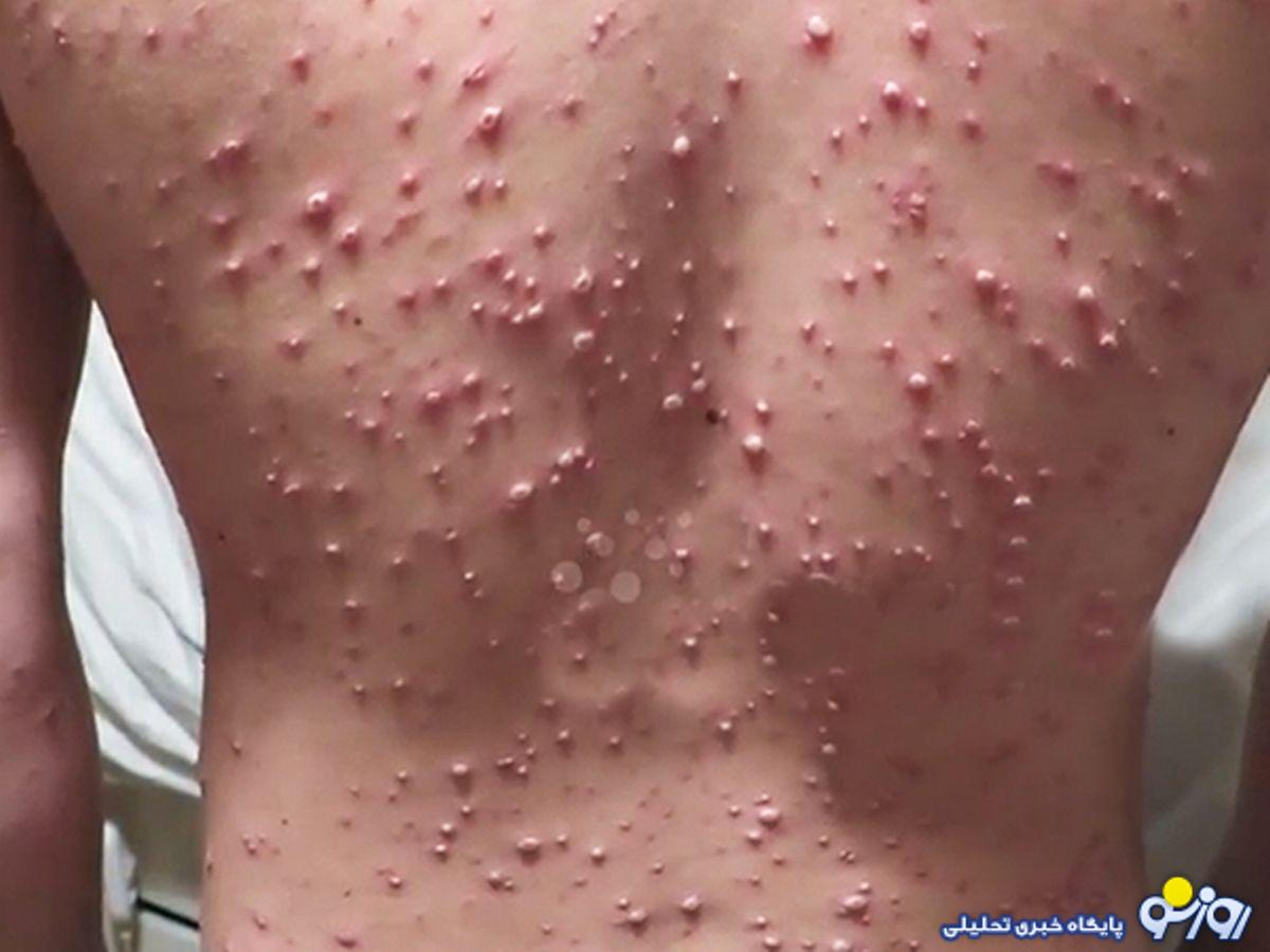 آشنایی با بیماری آبله مرغان
