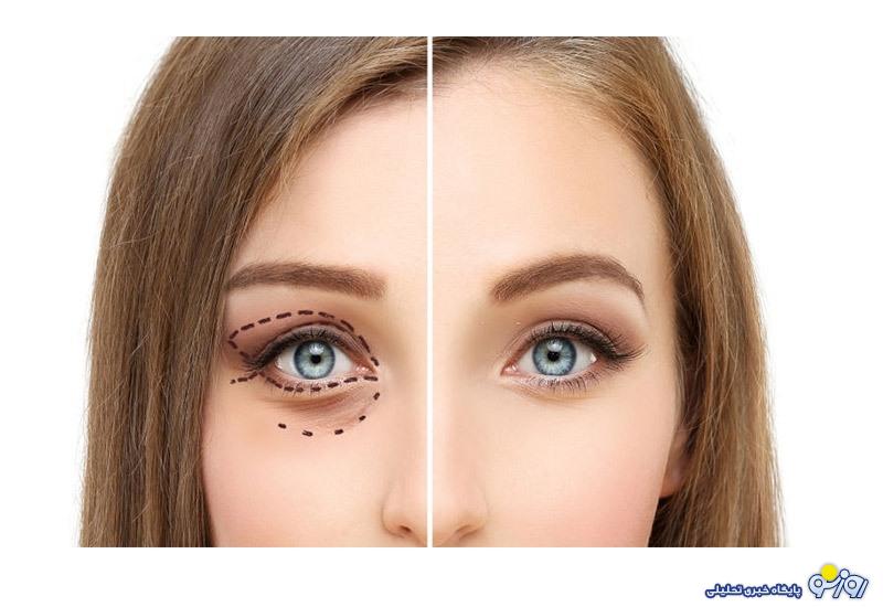 بلفاروپلاستی؛ تصمیمی هوشمندانه برای ارتقای ظاهر و کیفیت بینایی